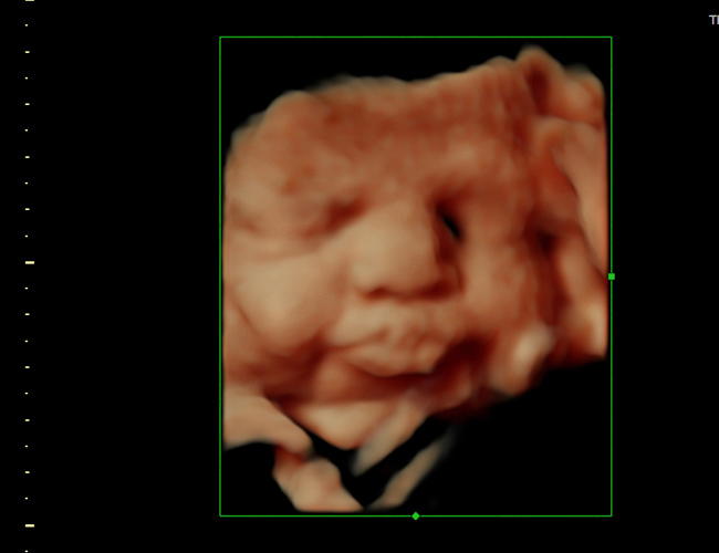 3D ultrasound image at 33 weeks